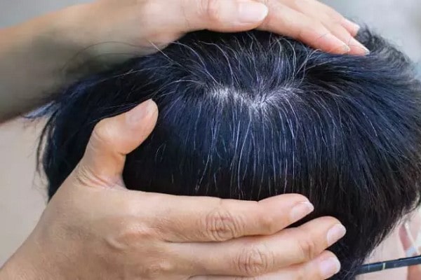 Trẻ Em Bị Tóc Bạc Sớm Là Bệnh Gì? 17 Trẻ Em Bị Tóc Bạc Sớm Là Bệnh Gì?