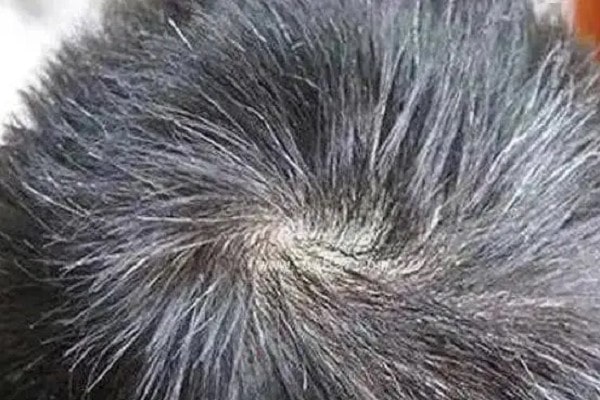 Trẻ Em Bị Tóc Bạc Sớm Là Bệnh Gì? 4 Trẻ Em Bị Tóc Bạc Sớm Là Bệnh Gì? 3