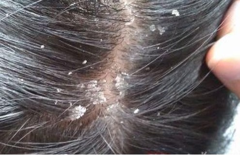Da Đầu Bị Gàu Từng Mảng: Nguyên Nhân, Điều Trị Và Phòng Ngừa Hiệu Quả 4 Da Đầu Bị Gàu Từng Mảng: Nguyên Nhân, Điều Trị Và Phòng Ngừa Hiệu Quả 3