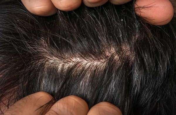 Tại Sao Gội Đầu Xong Vẫn Có Gàu? Nguyên Nhân Và Cách Khắc Phục 3 Tại Sao Gội Đầu Xong Vẫn Có Gàu? Nguyên Nhân Và Cách Khắc Phục 2