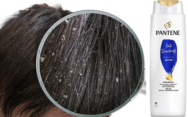 Dầu gội Pantene trị gàu hiệu quả không? 1 Dầu gội Pantene trị gàu hiệu quả không?