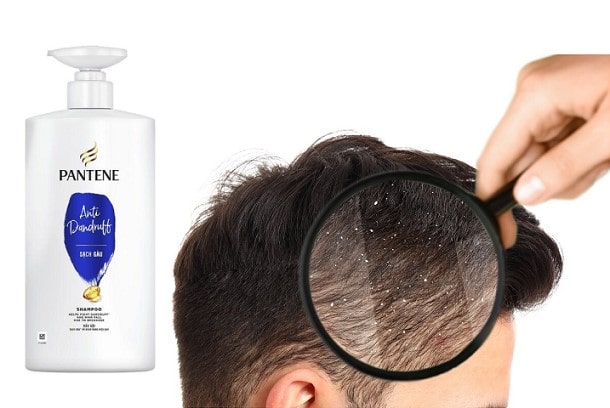 Dầu gội Pantene trị gàu hiệu quả không? 3