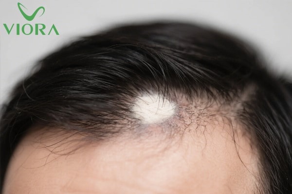 Tại Sao Tóc Rụng Không Mọc Lại? Nguyên Nhân Và Cách Khắc Phục 1 Tại Sao Tóc Rụng Không Mọc Lại? Nguyên Nhân Và Cách Khắc Phục