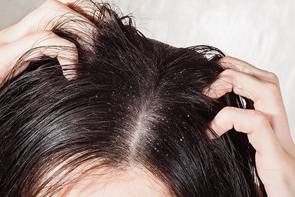 Da Đầu Ngứa Và Nhiều Gàu: Nguyên Nhân, Cách Điều Trị Hiệu Quả 1 Da Đầu Ngứa Và Nhiều Gàu: Nguyên Nhân, Cách Điều Trị Hiệu Quả