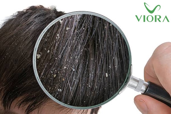 Dầu gội làm sạch gàu: Thành phần và cách lựa chọn đúng sản phẩm 3 Dầu gội làm sạch gàu: Thành phần và cách lựa chọn đúng sản phẩm 2