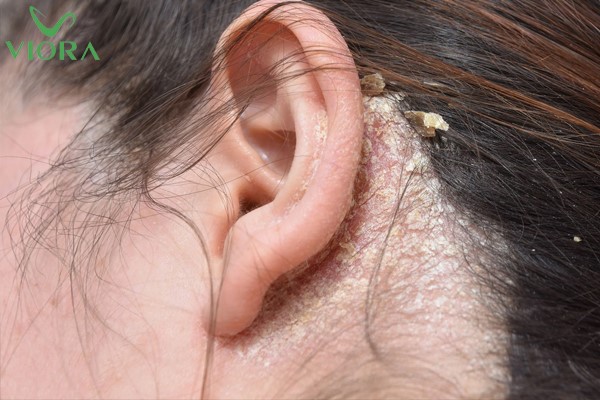 Dầu gội trị nấm đầu: Cơ chế tác dụng và cách chọn đúng sản phẩm hiệu quả 2 Dầu gội trị nấm đầu: Cơ chế tác dụng và cách chọn đúng sản phẩm hiệu quả 1