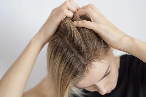 Nhuộm Tóc Xong Bị Gàu: Nguyên Nhân Và Cách Khắc Phục Hiệu Quả