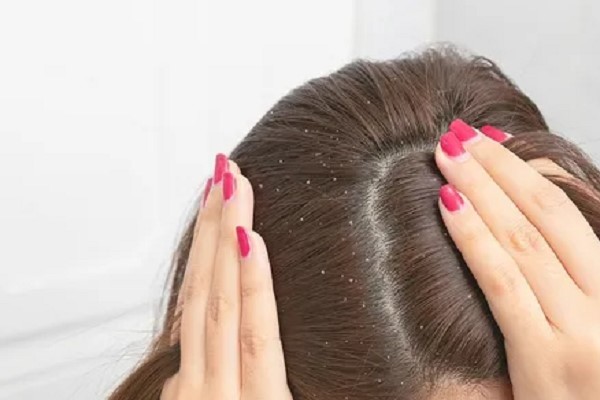Nhuộm Tóc Xong Bị Gàu: Nguyên Nhân Và Cách Khắc Phục Hiệu Quả 3