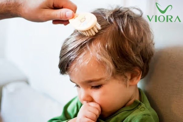 Dầu gội trị nấm da đầu ở trẻ em: Cách chọn đúng sản phẩm và dùng hiệu quả