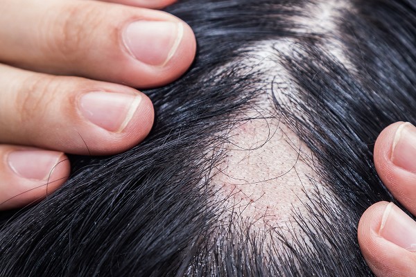 Bệnh Gì Gây Rụng Tóc? Tìm Hiểu Nguyên Nhân Và Giải Pháp Điều Trị 25 Bệnh Gì Gây Rụng Tóc? Tìm Hiểu Nguyên Nhân Và Giải Pháp Điều Trị