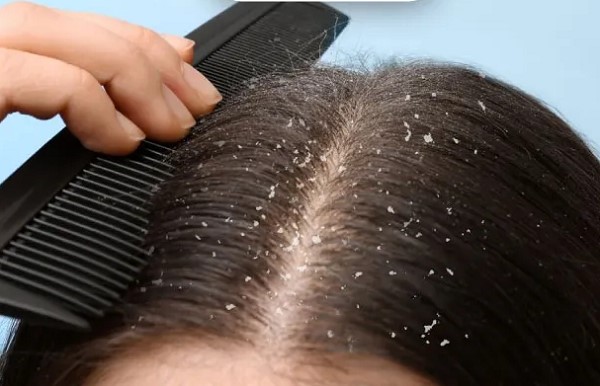 Các Loại Gàu: Nguyên Nhân, Triệu Chứng và Cách Khắc Phục