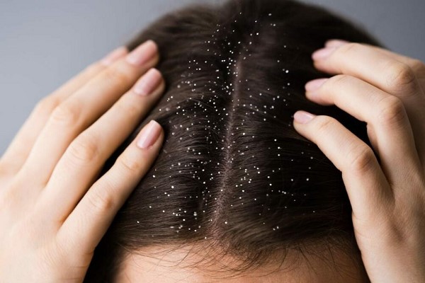 Các Loại Gàu: Nguyên Nhân, Triệu Chứng và Cách Khắc Phục 2