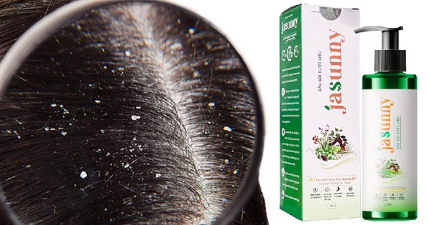 Dầu Gội Trị Gàu Jasunny Có Thực Sự Hiệu Quả Không? 1 Dầu Gội Trị Gàu Jasunny Có Thực Sự Hiệu Quả Không?