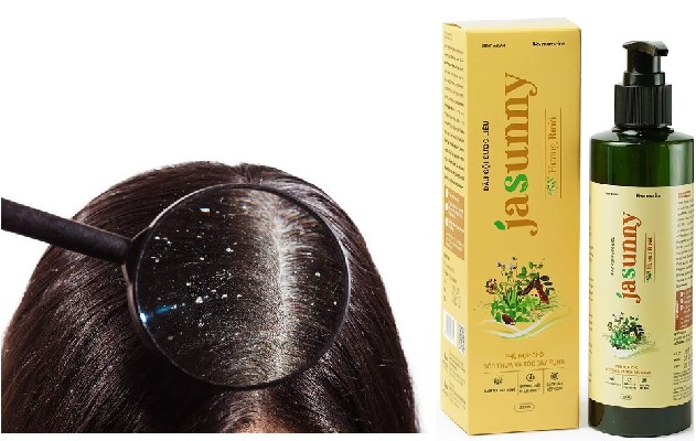 Dầu Gội Trị Gàu Jasunny Có Thực Sự Hiệu Quả Không? 2 Dầu Gội Trị Gàu Jasunny Có Thực Sự Hiệu Quả Không? 2