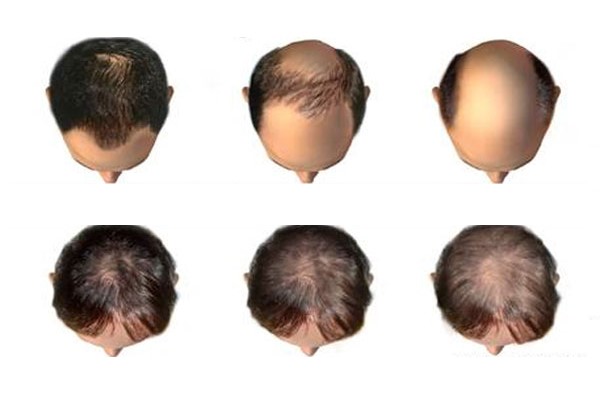 Rụng Tóc Nhiều Ở Nam Là Bệnh Gì? Nguyên Nhân Và Cách Khắc Phục Hiệu Quả