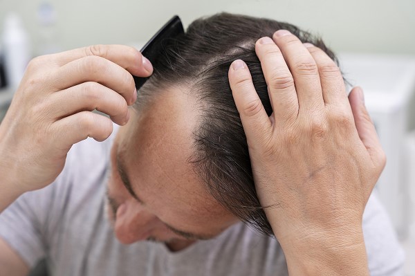 Rụng Tóc Nhiều Ở Nam Là Bệnh Gì? Nguyên Nhân Và Cách Khắc Phục Hiệu Quả 2 Rụng Tóc Nhiều Ở Nam Là Bệnh Gì? Nguyên Nhân Và Cách Khắc Phục Hiệu Quả 2