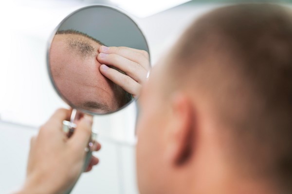 Rụng Tóc Nhiều Ở Nam Là Bệnh Gì? Nguyên Nhân Và Cách Khắc Phục Hiệu Quả 3 Rụng Tóc Nhiều Ở Nam Là Bệnh Gì? Nguyên Nhân Và Cách Khắc Phục Hiệu Quả 3