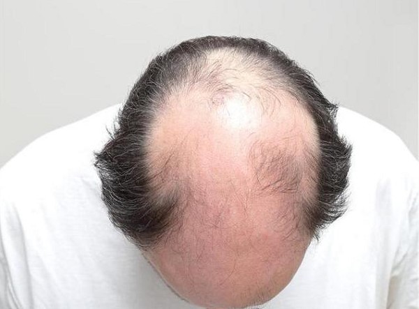 Nguyên Nhân Dẫn Đến Rụng Tóc - Vì Sao Tóc Bạn Ngày Càng Thưa Dần? 7 Nguyên Nhân Dẫn Đến Rụng Tóc - Vì Sao Tóc Bạn Ngày Càng Thưa Dần?