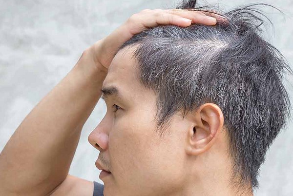 Tóc Bạc Sớm Ở Nam - Dấu Hiệu Cảnh Báo Sức Khỏe Bạn Không Nên Bỏ Qua 22 Tóc Bạc Sớm Ở Nam - Dấu Hiệu Cảnh Báo Sức Khỏe Bạn Không Nên Bỏ Qua