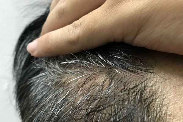 Tóc Bạc Sớm Ở Nam - Dấu Hiệu Cảnh Báo Sức Khỏe Bạn Không Nên Bỏ Qua 2 Tóc Bạc Sớm Ở Nam - Dấu Hiệu Cảnh Báo Sức Khỏe Bạn Không Nên Bỏ Qua 2