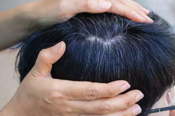 Tóc Bạc Sớm Ở Nam - Dấu Hiệu Cảnh Báo Sức Khỏe Bạn Không Nên Bỏ Qua 3 Tóc Bạc Sớm Ở Nam - Dấu Hiệu Cảnh Báo Sức Khỏe Bạn Không Nên Bỏ Qua 3