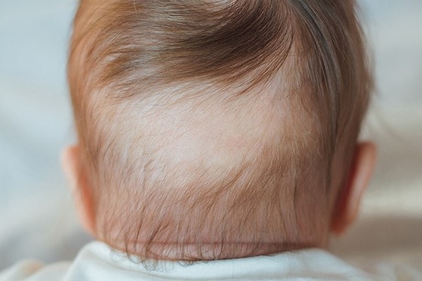 Trẻ Bị Rụng Tóc Vành Khăn Nên Uống Gì? 19 Trẻ Bị Rụng Tóc Vành Khăn Nên Uống Gì?