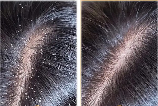 Trị Gàu Bằng Muối Có Thực Sự Hiệu Quả Không? 13 Trị Gàu Bằng Muối Có Thực Sự Hiệu Quả Không?