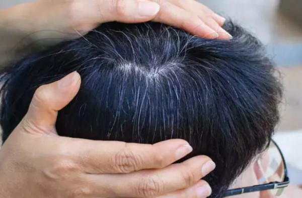Cách trị bệnh tóc bạc ở trẻ em: Nguyên nhân và giải pháp hiệu quả 2 Cách trị bệnh tóc bạc ở trẻ em: Nguyên nhân và giải pháp hiệu quả 2