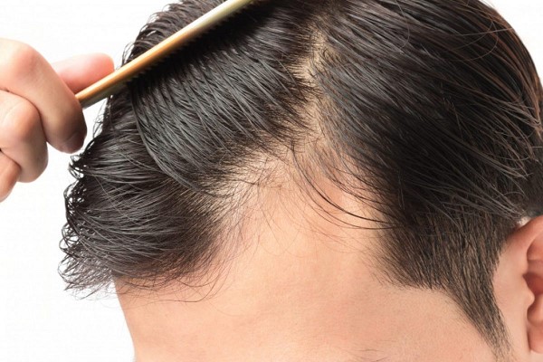Tóc Rụng Nhiều Có Nên Cắt Ngắn? Giải Pháp Chăm Sóc Tóc Hiệu Quả