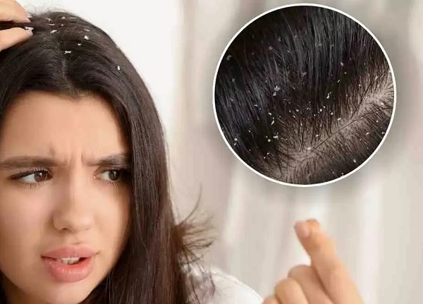 Trị Gàu Bằng Aspirin: Những Điều Cần Biết Và Hướng Dẫn Cách Làm 1 Trị Gàu Bằng Aspirin: Những Điều Cần Biết Và Hướng Dẫn Cách Làm