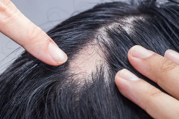 Bệnh Rụng Tóc Từng Mảng: Vì Sao Xảy Ra Và Có Cách Nào Điều Trị Hiệu Quả?