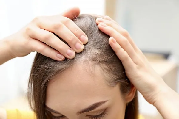 Bệnh Rụng Tóc Từng Mảng: Vì Sao Xảy Ra Và Có Cách Nào Điều Trị Hiệu Quả? 2 Bệnh Rụng Tóc Từng Mảng: Vì Sao Xảy Ra Và Có Cách Nào Điều Trị Hiệu Quả? 2
