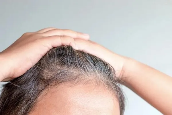 Tác Hại Của Việc Nhổ Tóc Bạc - Cảnh Báo Từ Chuyên Gia Da Liễu 3