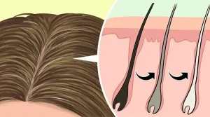 Tại Sao Tóc Bạc Sớm? Nguyên Nhân Và Cách Khắc Phục Hiệu Quả