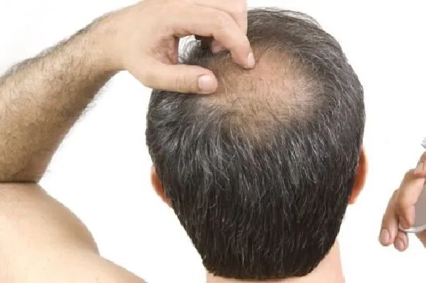 Thuốc Giảm Rụng Tóc Là Gì? Có Thực Sự Hiệu Quả? 1 Thuốc Giảm Rụng Tóc Là Gì? Có Thực Sự Hiệu Quả?